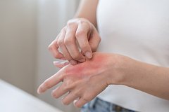 Открыт неожиданный механизм возникновения аллергии