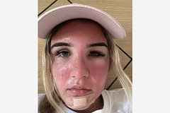 Туристка погрелась на солнце в Мексике и стала похожа на «укушенную осой собаку»